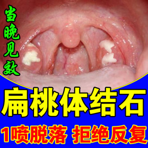 扁桃体结石去除工具吸引清除神器咽喉异物感肥肿痛发炎喷剂漱口水