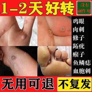 点鱼鳞痣去鱼鳞