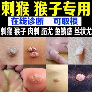 止忧净去除手足肉刺猴子鱼休子扁平尤鸡老茧眼膏贴尤净神器去猴灵