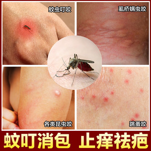 治疗跳蚤药膏螨虫蚊虫叮咬止痒消红肿隐翅毒虫臭虫子专用软膏人用