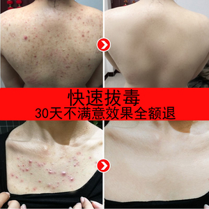 后背祛痘去除前胸背痘痘背部起疙瘩痤疮脓包螨虫皮肤过敏止痒药膏