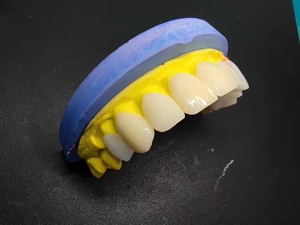 超薄瓷贴面进口义获嘉蓝瓷vita琥珀全瓷美白贴片牙缝断牙烤瓷陶瓷