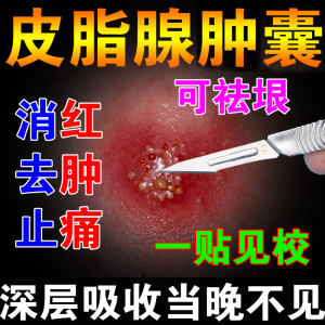 皮脂腺囊肿膏去皮下囊肿粉瘤脓包型痤疮痘痘火疖子拔毒拔脓神器贴