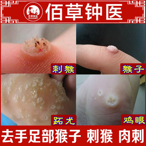 去猴子脚刺猴去除正品祛水猴子小肉粒手部鱼鳞痣肉刺去除膏休子