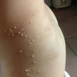 儿童去病毒性软疣药膏祛除成人宝宝去除膏治疗水猴子药caiye60638