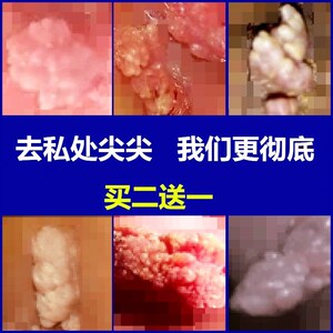 00tb139152299淘宝克疣液去丝状疣颈部头部瘊子专除私处疣尖锐病毒