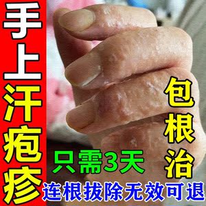 治疗汗状疱疹手上小水泡汗泡疹去手痒手部湿疹根蜕皮干裂止痒药膏