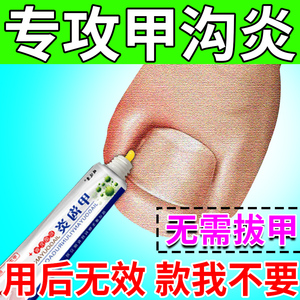 治疗甲沟炎神器