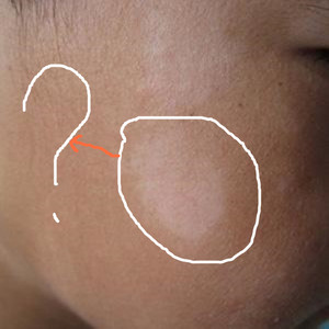 儿童小孩婴幼儿小儿脸上白斑白点点白块白色糠康桃花鲜