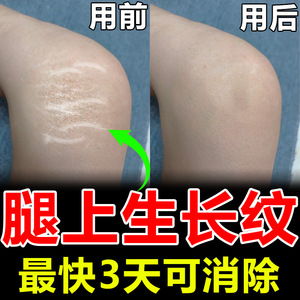 消除腿上肥胖纹生长纹淡化大腿生长纹修复霜祛妊娠纹学生专用男女