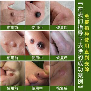 瘊子去皮肤疣跋疣脚上长肉丁刺根去除膏足部甲周疣专用药跋疣外用