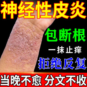 治疗神经性皮炎去根除外用膏顽固皮肤病癣藓湿疹真菌感染无激素药