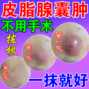 皮脂腺囊肿型坐板脓疮药膏火疖子拔毒拔脓贴皮下粉瘤痘痘痤疮屁股