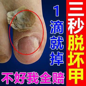 脱甲膏灰指甲治疗真菌感染灰甲抑菌液去除增厚抗菌正品专用特效药
