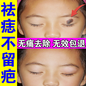 去痣点痣的药膏无痕正品脸部专用祛痣去瘊子扁平疣取黑痣修复神器