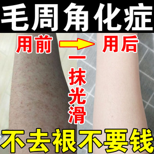 毛周角化症毛孔堵塞疏通毛囊角化红斑黑变病鸡皮肤疙瘩药儿童脸面
