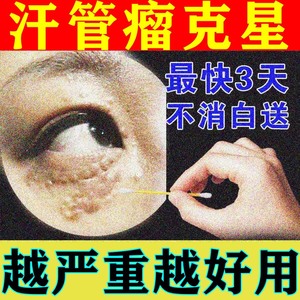 汗管瘤眼部专用药去除神器治疗眼部脂肪粒眼霜多发性淡褐色丘疹膏