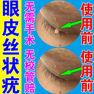 去眼睛丝状疣眼皮上的小肉粒脖子瘊子去除神器治扁平疣面部专用药
