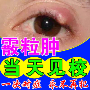 霰粒肿热敷眼贴眼睑板腺疏通眼睛模糊儿童眼皮红肿痒麦粒肿散粒肿