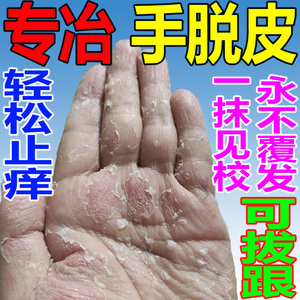 手脱皮起皮专用膏药真菌感染手上爆皮干燥脱皮手裂开干裂止痒软膏