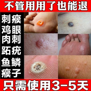 去猴子的药肉粒疙瘩瘊子肉刺猴去除正品神器鱼鳞痣脚跖疣专用药膏