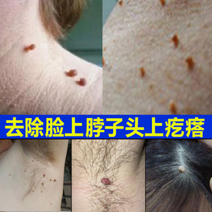 去猴子脖子上长的小肉粒疙瘩药痦子腋下皮赘祛除瘊子肉痣正品神器