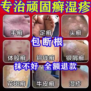 湿癣膏