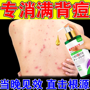 背上长痘痘药膏除螨虫人用前胸后背治闭口粉刺克星毛囊炎祛痘神器
