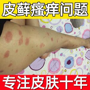 鲜治疗牛皮屑的药牛皮癣银屑湿疹皮肤病专用手藓药膏真菌感染外用