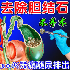 胆结石溶石化石【100%碎石】肾结石排石中草药贴胆排结石非茶神器