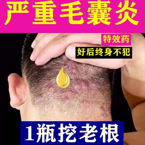 治头皮毛囊炎专用头部脖子前胸后背私处马拉色菌痘痘中药酊的膏药