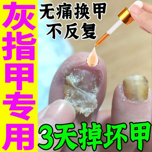 凤仙花灰指甲抑菌液甲依恋涂剂碘伏白醋碘酒碘酊软化苗古汤灰修复