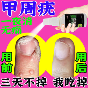 甲周疣专用药大人儿童甲下疣跖疣特效药去除足部去痣去扁平疣神器