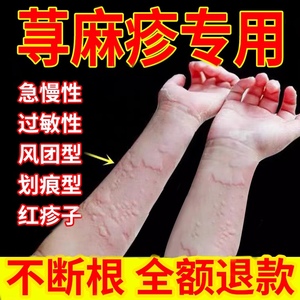 荨麻疹过敏止痒断根专用药胆碱能性皮肤瘙痒丘疹性寻荨麻疹药膏