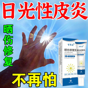 神经性日光性皮炎去根除无激素抗紫外线过敏皮肤瘙痒止痒专用药膏