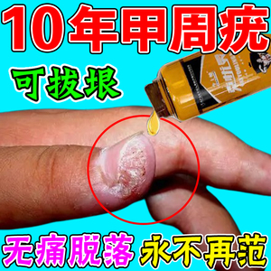 儿童甲周疣专用药手脚长疣祛疣瘊子扁平疣药膏药水刺猴肉疣去除