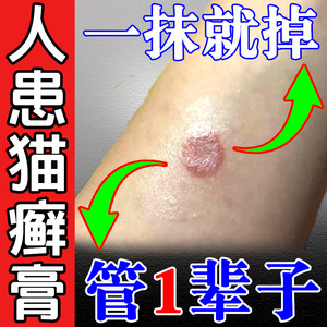 人用的猫癣药