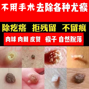 801508人付款淘宝祛肉瘤皮赘去除膏猴子脖子上长的小肉粒疙瘩腋下瘊子