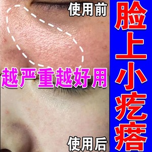 毛周角化面部去鸡皮肤疙瘩毛囊角质药膏修复儿童脸部橘皮起皮刷酸