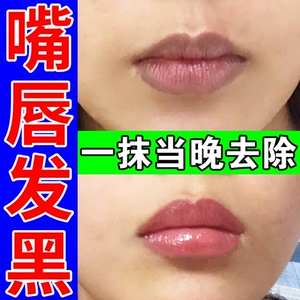 嘴角发黑去除唇部下巴周边围暗沉美白改善淡化唇纹色去角质黑色素