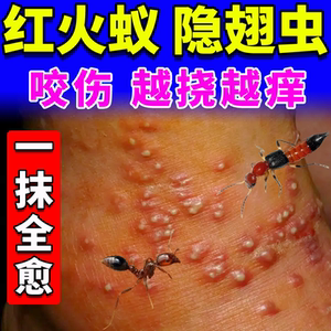 红火蚁药膏隐翅虫蚂蚁咬伤臭虫跳蚤蜈蚣叮咬瘙痒烧灼疼痛止痒消肿