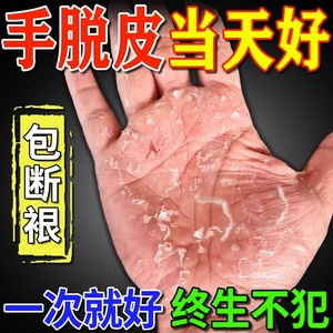 手足脱皮膏手上起皮干燥蜕皮专用治疗严重手指手掌脚底干裂褪皮掉