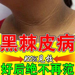 脖子黑黑的黑棘皮症去除黑色素沉淀洗不干净私处全身关节美白乳膏