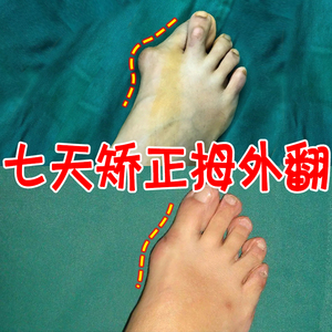 拇指外翻贴大拇指外翻矫正器女士大脚骨脚趾重叠关节变形专用膏贴
