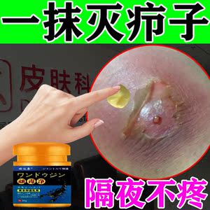 火疖子拔毒拔脓膏治红肿疙瘩硬块痘痘疖子软膏药贴坐板疮吸脓神器