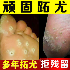 鸦胆子跖疣膏猴子手上脚上长硬疙瘩肉粒趾根瘊子净祛非去除非专用