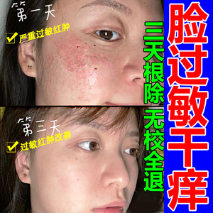 脸上过敏皮肤痒药膏脱皮干燥修复脸部红疹痒脂溢性皮炎激素脸止痒