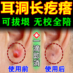 耳洞增生疙瘩护理液耳朵发炎清洁消炎专用药疤痕增生凸起去除疙瘩
