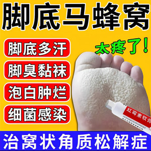 治蜂窝状脚气窝状角质松解症脚底马蜂窝脚掌小坑脚底粘腻酸臭疼痛