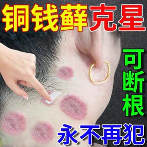 铜钱癣药膏皮肤瘙痒红斑外用止痒金钱脖子手肘癣牛皮癣头癣专用药